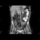 Carcinoma of pancreas: CT - Computed tomography